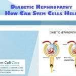 Stem Cell Therapy