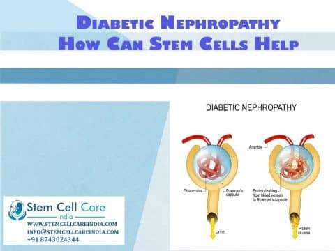 Stem Cell Therapy