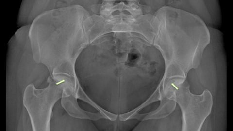 Avascular Necrosi in India