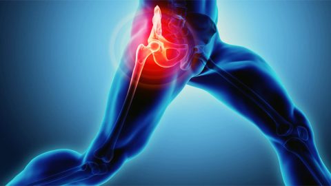 Stem Cell Treatment for Avascular Necrosis in India