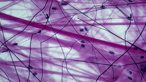 Stem Cell Treatment for Connective Tissue in India