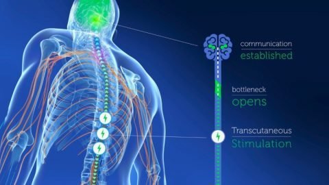 Epidural stimulation Treatment in India