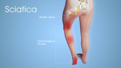 Stem Cell Treatment for Sciatic Nerve Injury & Sciatica India