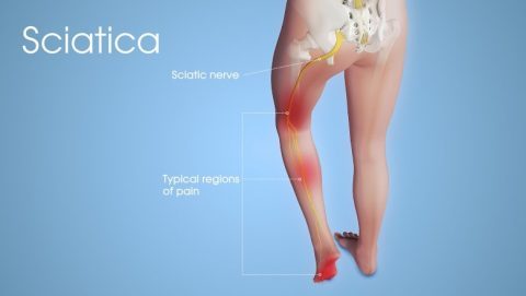 Stem Cell Treatment for Sciatic Nerve Injury & Sciatica India