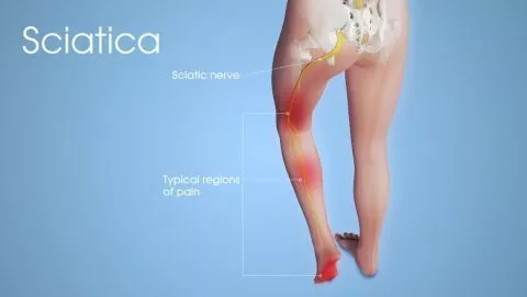 Stem Cell Treatment for Sciatic Nerve Injury & Sciatica India