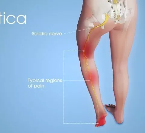 Sciatic Nerve Injury