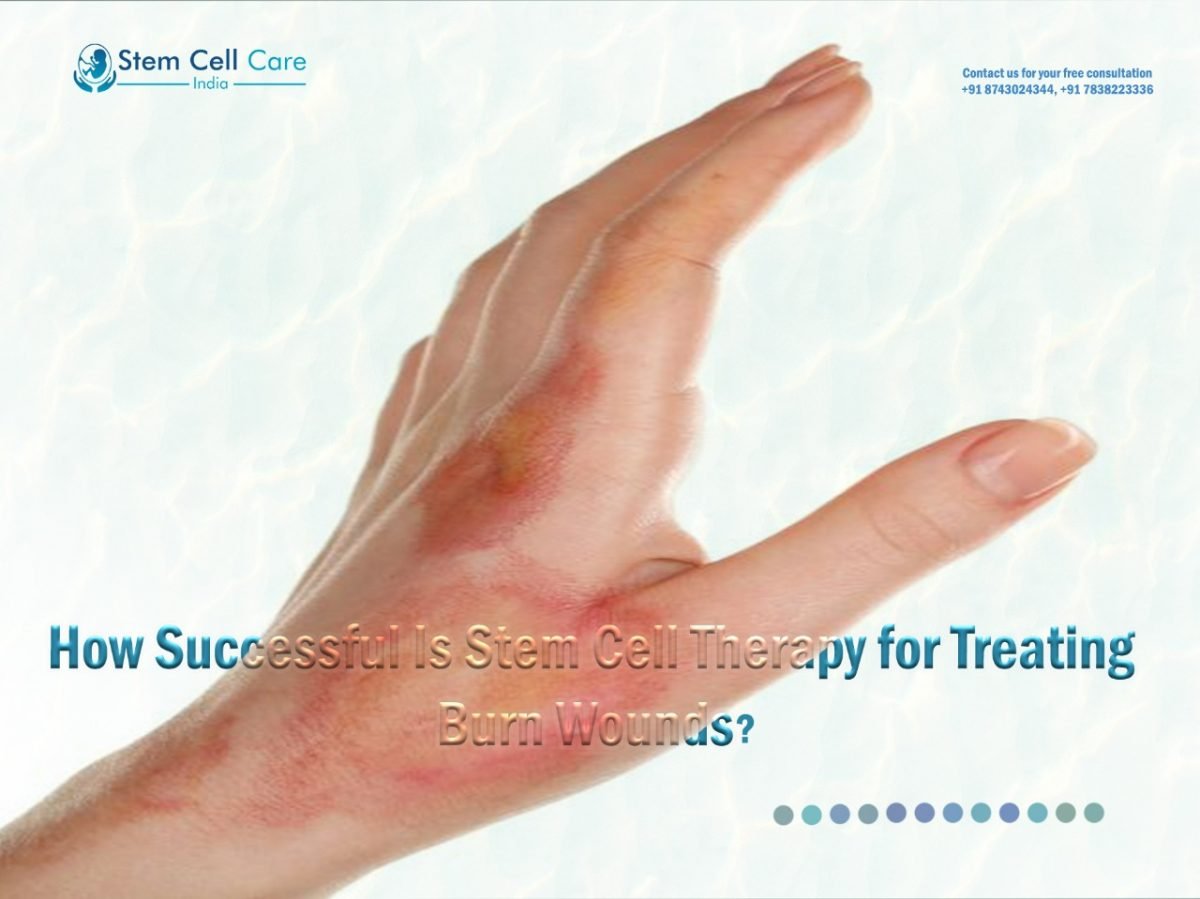 How Successful Is Stem Cell Therapy for Treating Burn Wounds