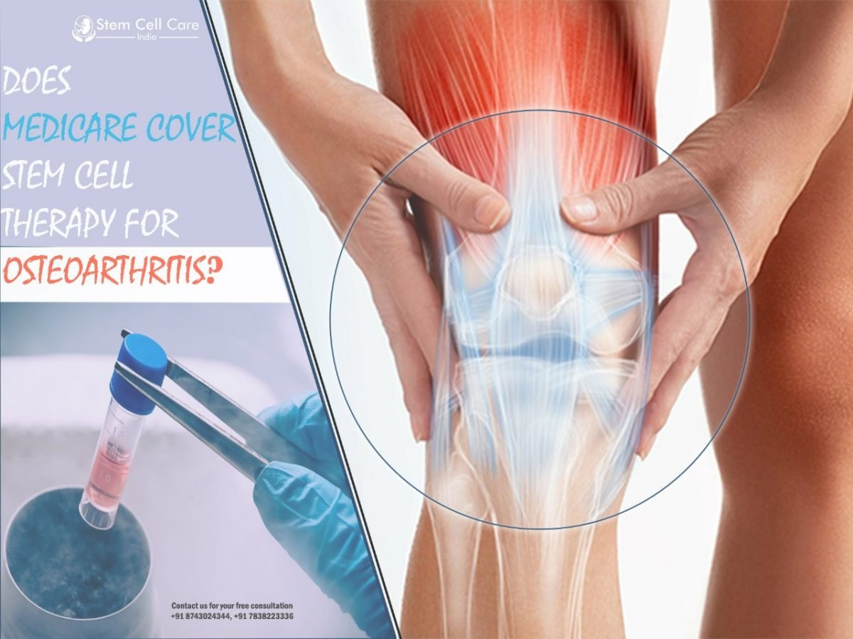 Does Medicare Cover Stem Cell Therapy for Osteoarthritis?