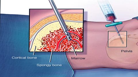 Bone Marrow Transplant for Severe Aplastic Anemia