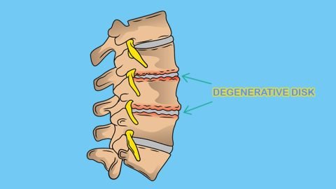 Degenerative Disk