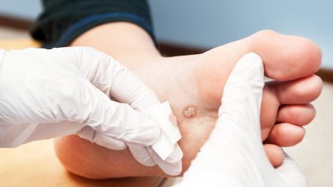 Diabetic Foot Ulcers