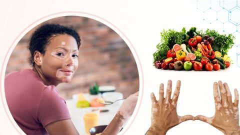 Diet tips for Vitiligo
