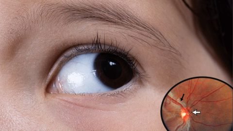 Optic-nerve-hypoplasia