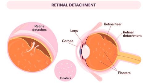 Retinal Detachment Patient