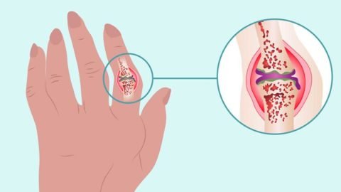 Rheumatoid-Arthritis