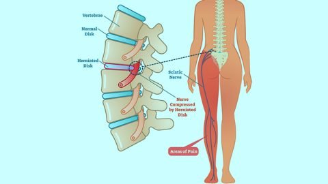 Sciatic-Nerve-Injury-&-Sciatica