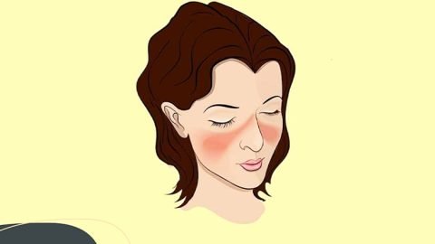 Systemic Lupus Patient