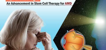 Age-related macular degeneration