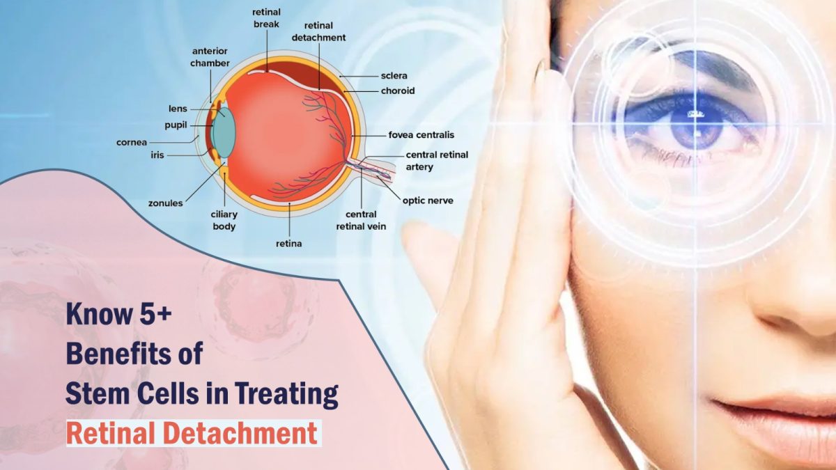 Know 5+ Benefits of Stem Cells in Treating Retinal Detachment