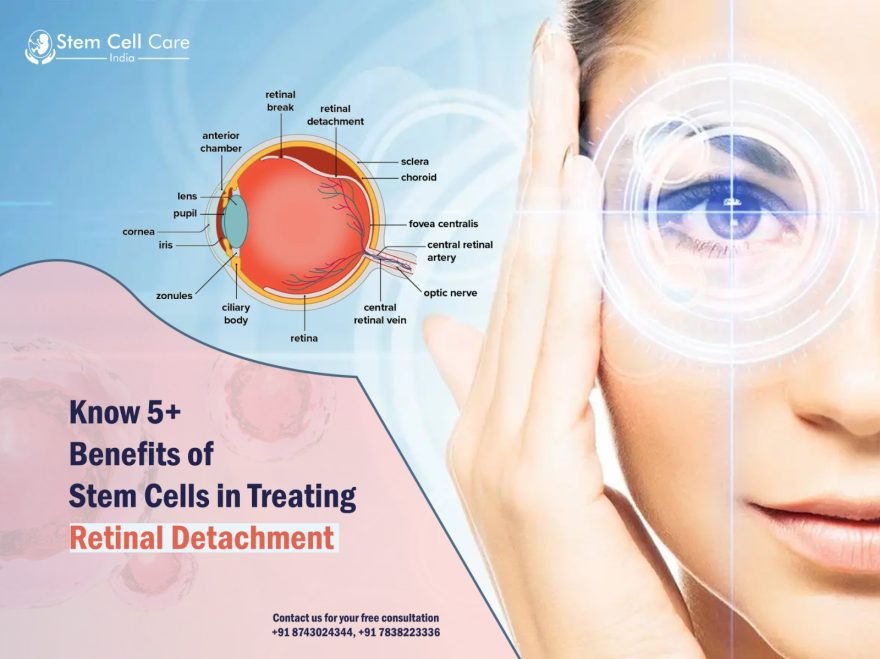 Know 5+ Benefits of Stem Cells in Treating Retinal Detachment