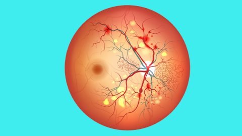 retinopathy