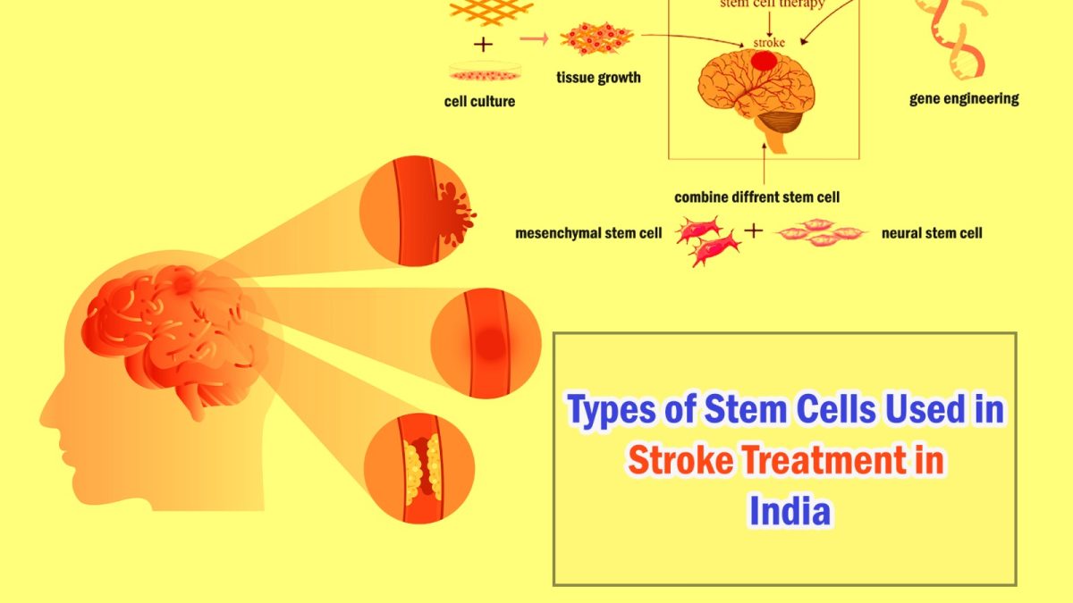 Types of Stem Cells Used in Stroke Treatment in India