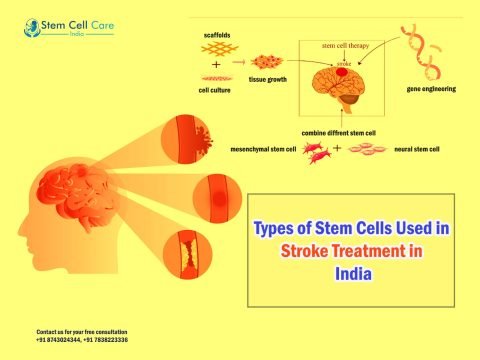 Types of Stem Cells Used in Stroke Treatment in India