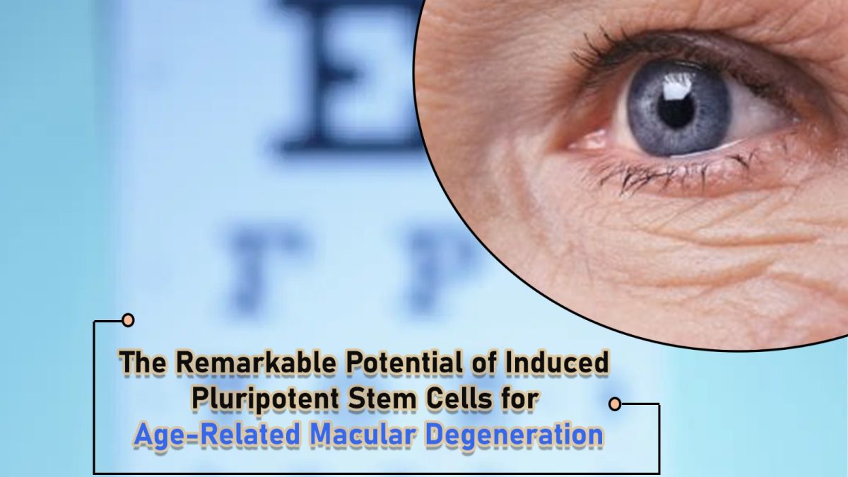 The Remarkable Potential of Induced Pluripotent Stem Cells for Age-Related Macular Degeneration