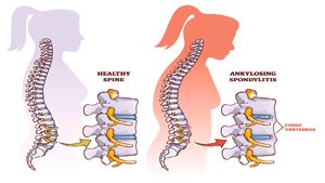Ankylosing spondylitis