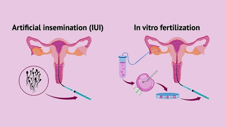 IVF In Vitro Fertilization Artificial Insemination- Stem Cell Care India