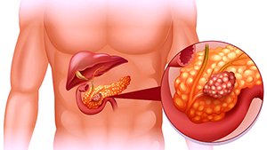 Pancreatitis