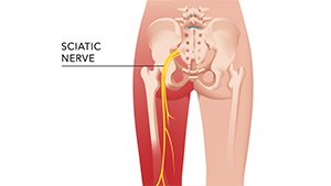 Sciatic Nerve Injury