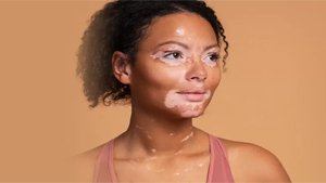 Vitiligo