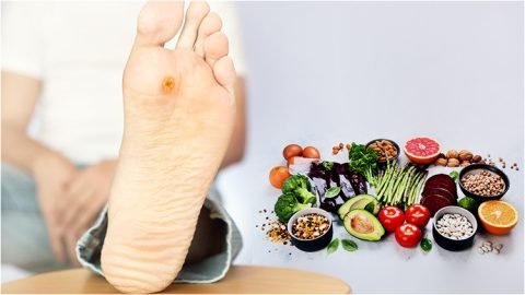 Diabetic Foot Ulcers