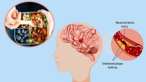 Stroke disease