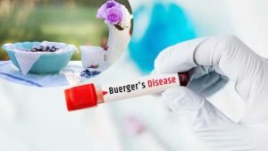 burger Disease