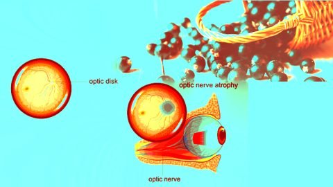 optic nerve atrophy