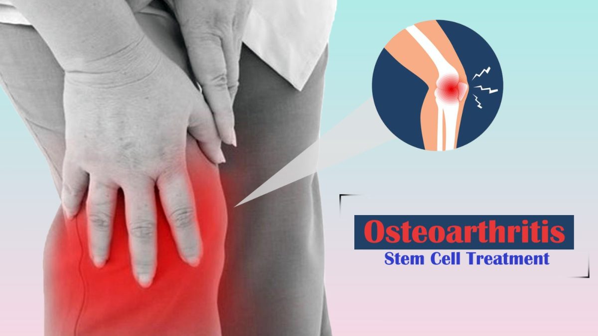How Osteoarthritis Stem Cell Treatment Can Help a Patient?