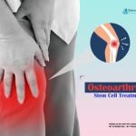 How Osteoarthritis Stem Cell Treatment Can Help a Patient?
