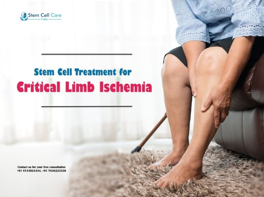 How Stem Cells Work for Treatment of Critical Limb Ischemia?