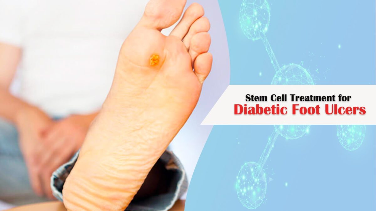 What is The Impact of Stem Cell Treatment on Diabetic Foot Ulcers?