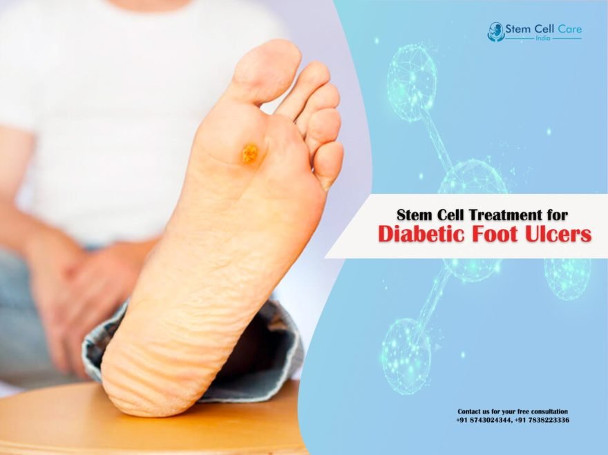 What is The Impact of Stem Cell Treatment on Diabetic Foot Ulcers?