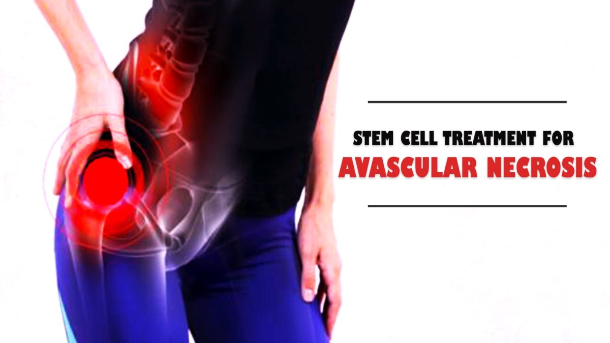 Why Choose Stem Cell Treatment for Avascular Necrosis?