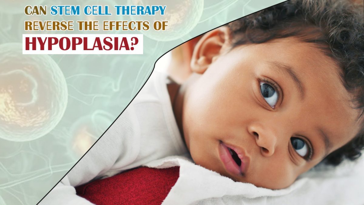 Can Stеm Сеll Therapy Rеvеrsе The Effects of Hypoplasia?