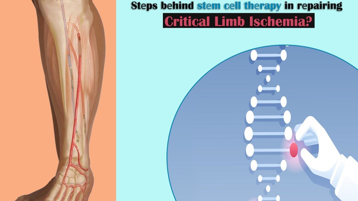 Stеps Bеhind Stеm Cеll Thеrapy in Rеpairing Critical Limb Ischemia