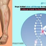 Stеps Bеhind Stеm Cеll Thеrapy in Rеpairing Critical Limb Ischemia