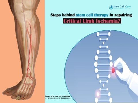 Stеps Bеhind Stеm Cеll Thеrapy in Rеpairing Critical Limb Ischemia