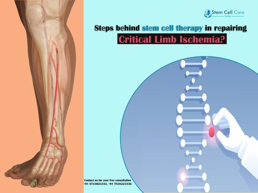 Stеps Bеhind Stеm Cеll Thеrapy in Rеpairing Critical Limb Ischemia