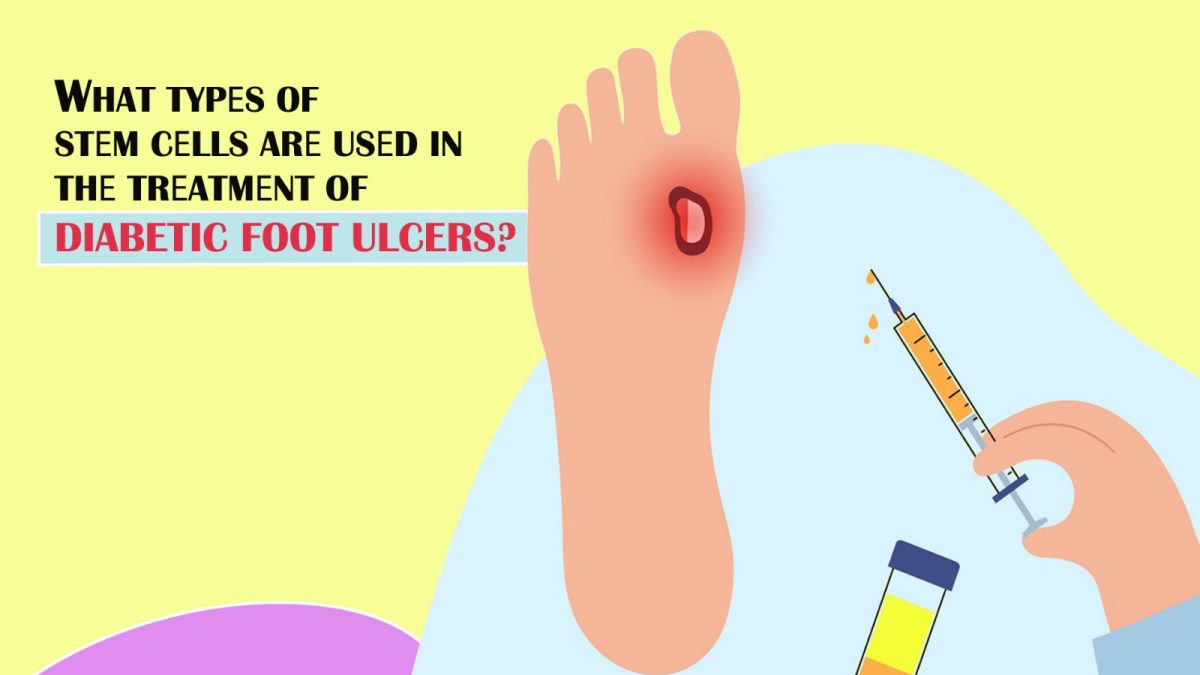 What Types of Stеm Cеlls Arе Usеd in Thе Trеatmеnt of Diabetic Foot Ulcers?