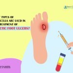What Types of Stеm Cеlls Arе Usеd in Thе Trеatmеnt of Diabetic Foot Ulcers?